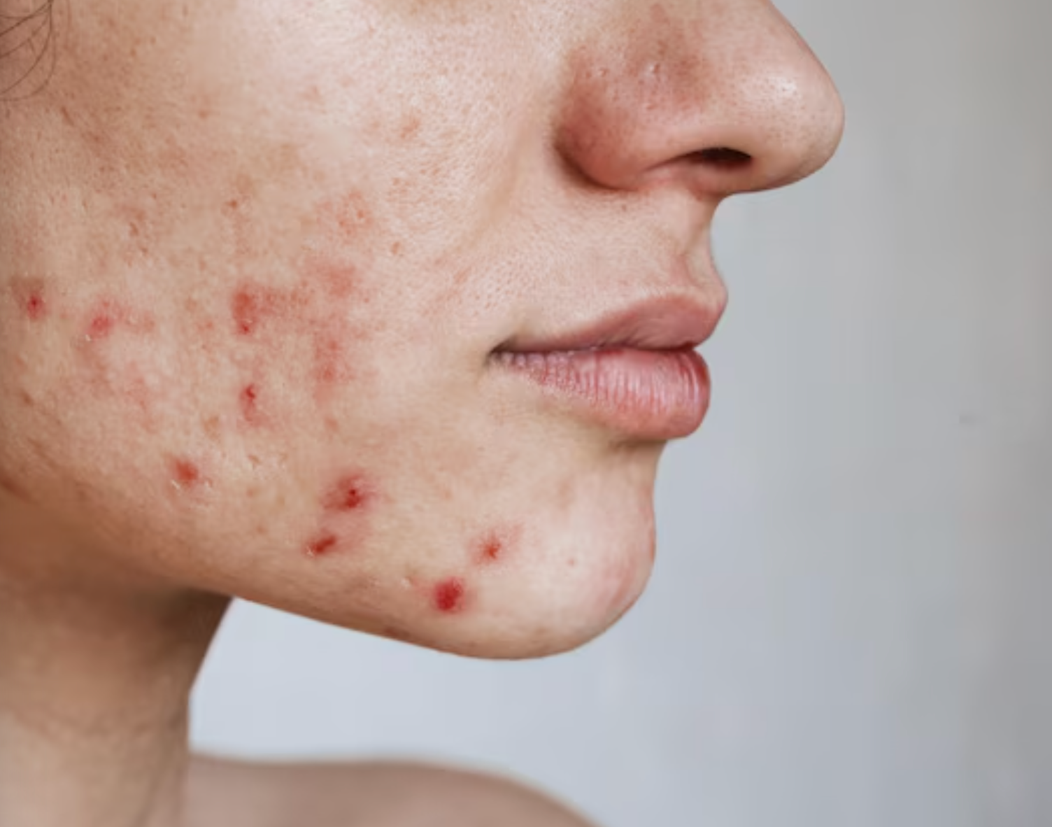 Penyebab Jerawat Hormonal dan Cara Mengatasinya Secara Medis
