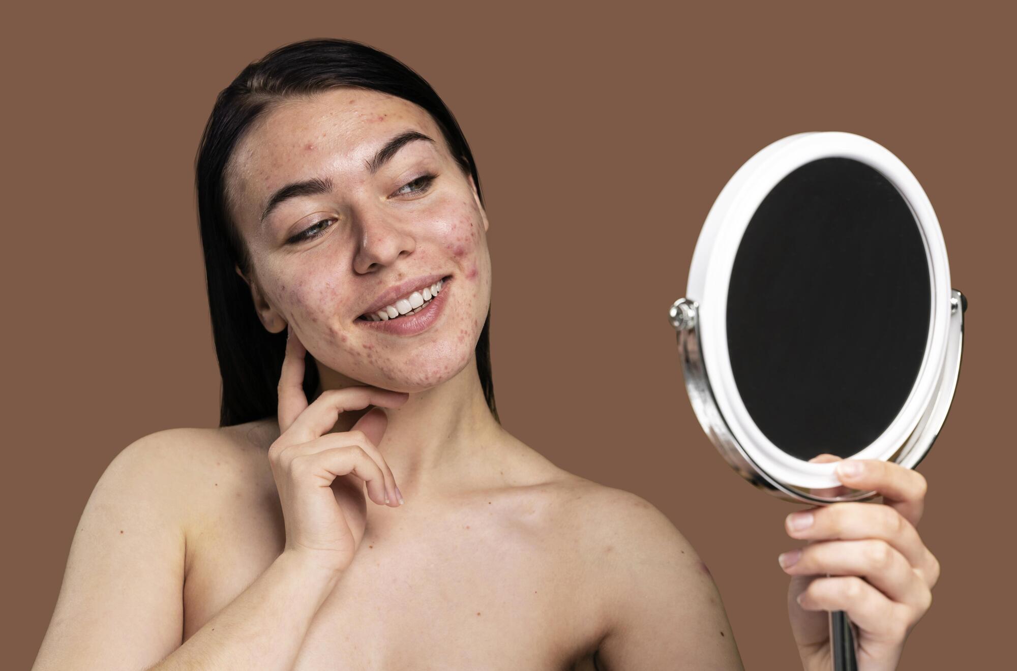 Tips Memilih Skincare Untuk Kulit Berjerawat, Apa Saja Yang Perlu Diperhatikan?