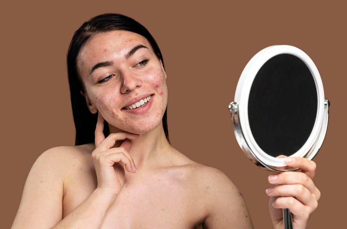 Tips Memilih Skincare untuk Kulit Berjerawat: Panduan Lengkap & Efektif
