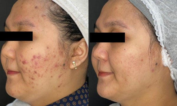 Acne Scar