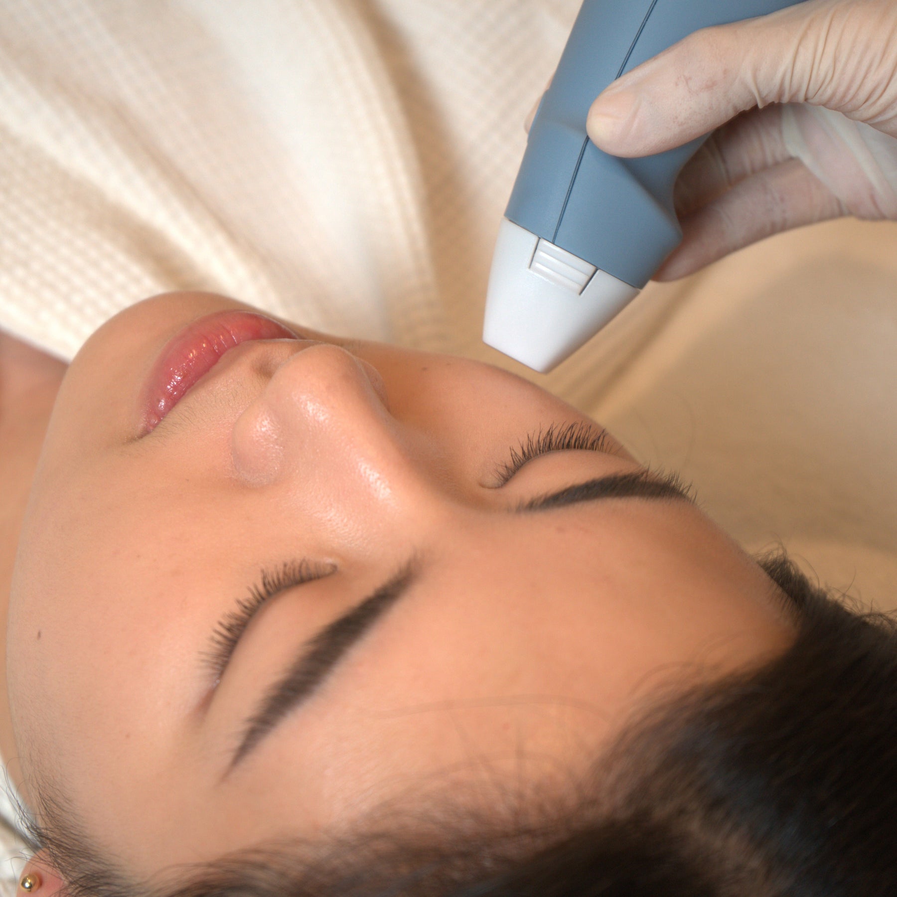RF microneedling face pen with small treatment tip held against forehead