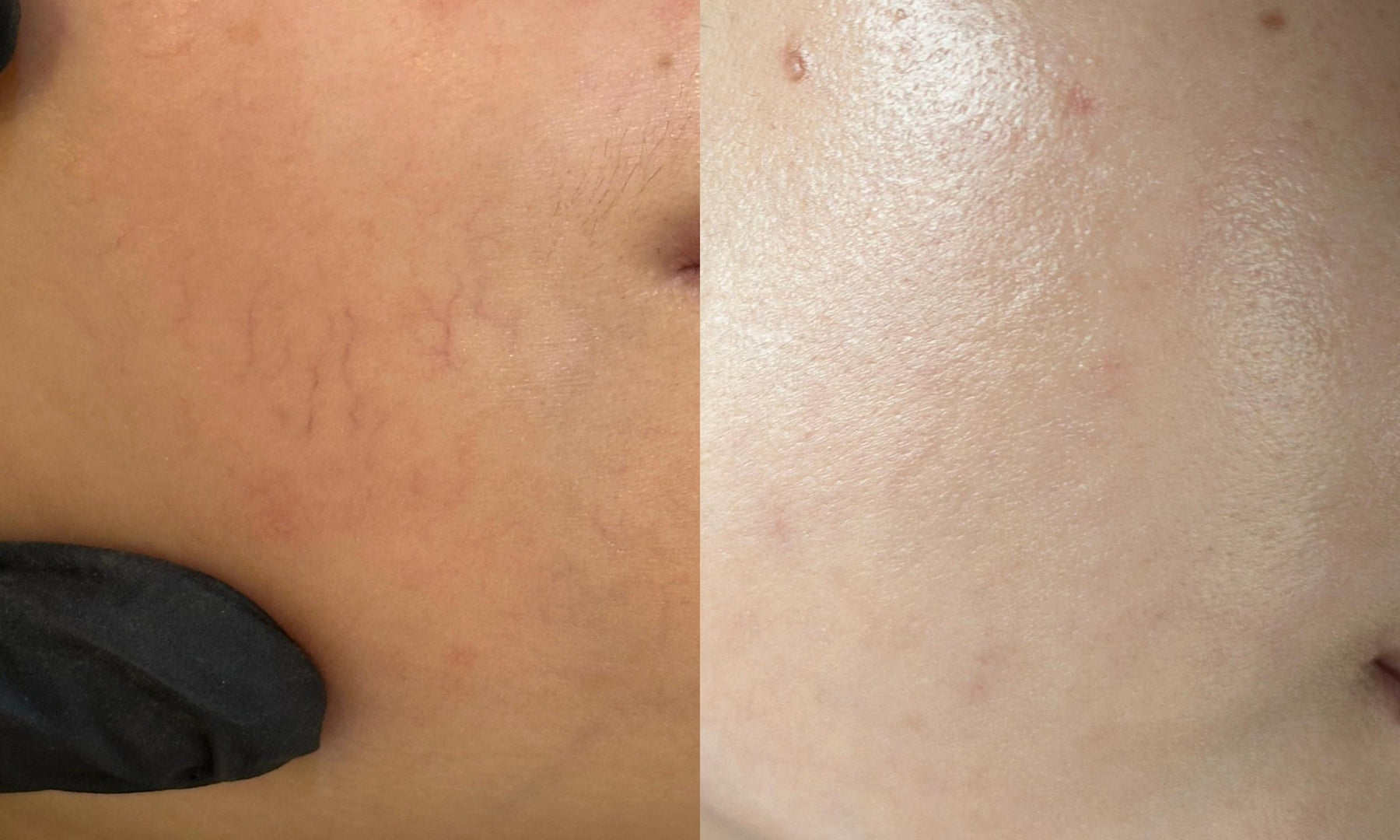 Foto before-after perawatan laser Excel-V untuk pembuluh darah halus di ADC Aesthetic Derma Centre